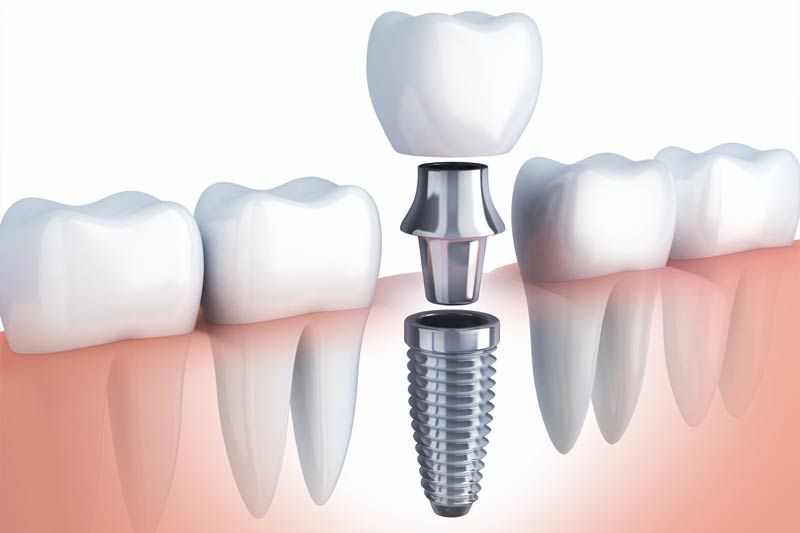 Dental Implant Restoration in Kansas City